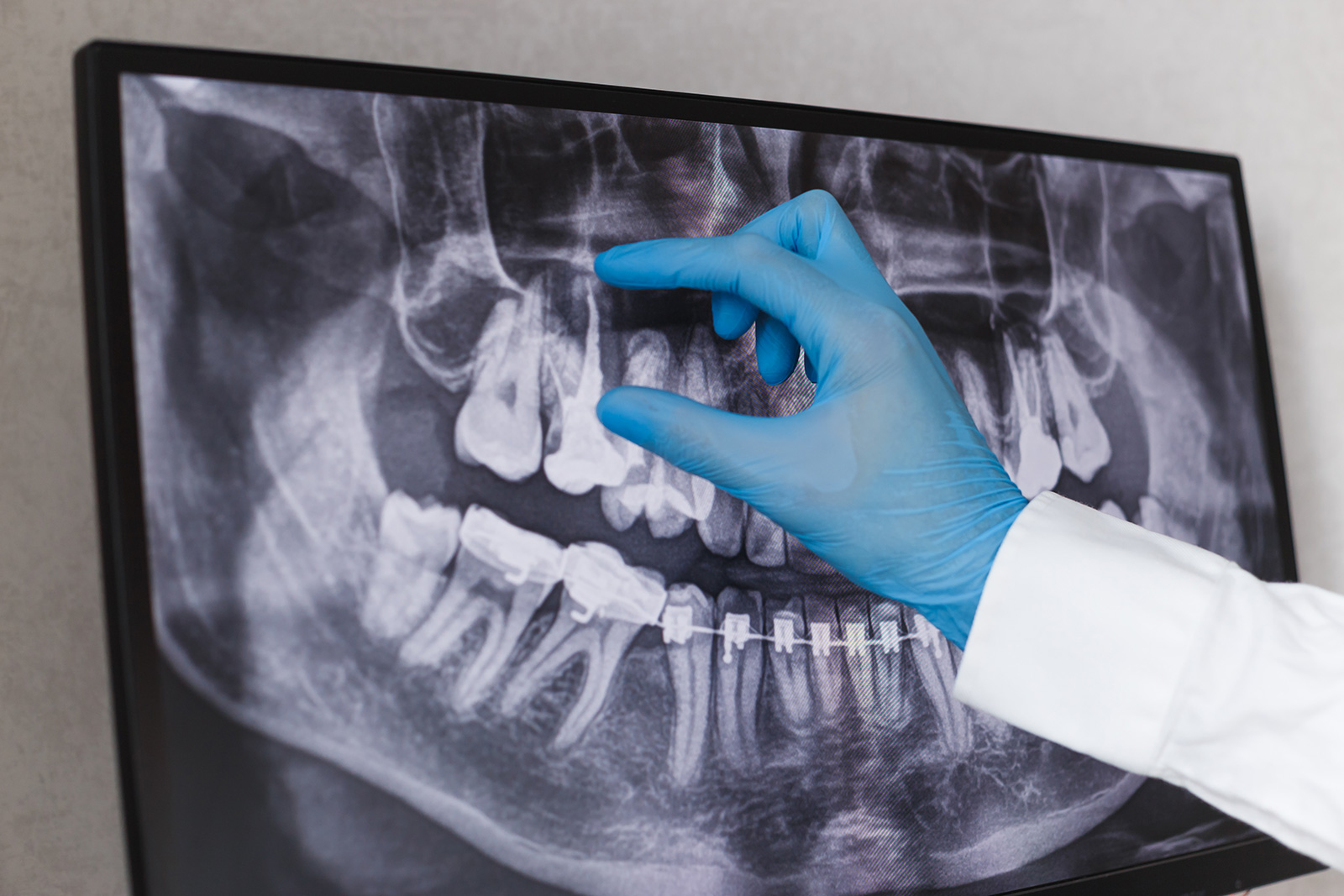 Endodontie – Wurzelkanalbehandlung